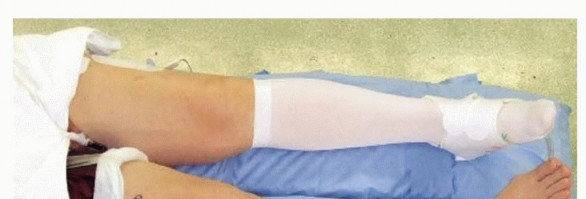 Illustration 3 for High Tibial Osteotomy: Realignment for Lasting Knee Pain Relief