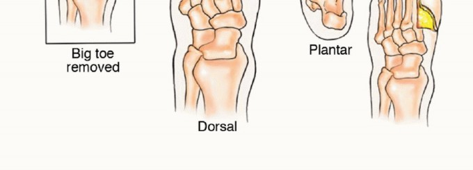 Illustration 21 for Treating Tumors of the Foot: Optimizing Amputation & Resection