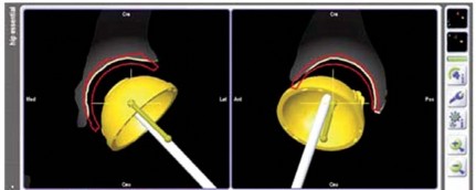 Illustration 25 for Minimizing Risks: Computer Navigation in Hip Resurfacing Arthroplasty