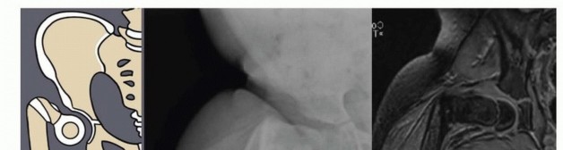 Illustration 3 for Treatment for Congenital Femoral Deficiency: What You Need to Know