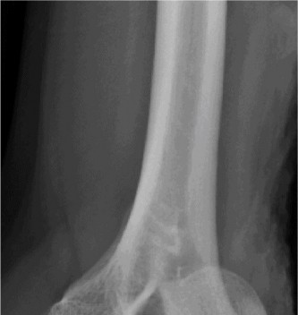 Illustration 4 for Complex Elbow Dislocation: Demystifying the Posteromedial Case