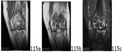 Orthopedic Reconstruction MCQs: Here, the question is question.