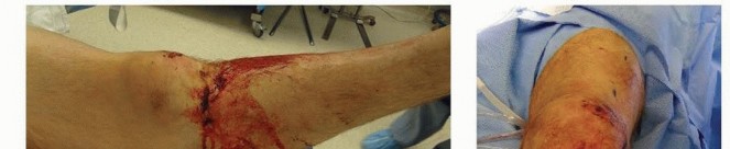 Illustration 36 for Tibia External Fixation: See How Pins Are Placed for Healing