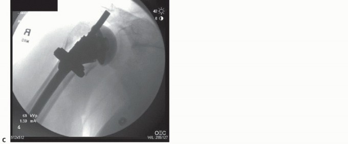 Illustration 27 for Hemiarthroplasty for Proximal: Effective Treatment for Fractures