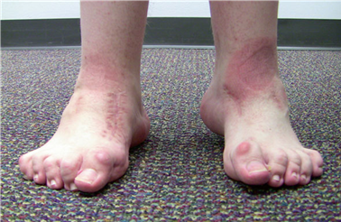 Illustration 92 for First Metatarsal Surgery: Expert Solutions for Foot & Ankle Pain