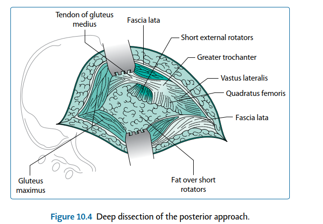 Illustration 21 for Mastering Short External Rotators for Optimal Hip Surgery Results