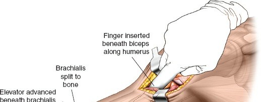 Illustration 27 for Mastering the Approach to the Distal Humerus: Safety & Skills