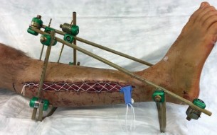 Illustration 10 for Complex Tibial Shaft Fracture: Plate Fixation for Plafond Extension