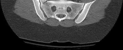 Illustration 188 for OrthoCash: Trauma MCQs & Cases for a yearold woman