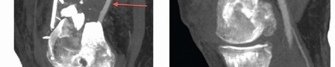 Illustration 8 for Repairing Distal Femur Fractures: Open Reduction & Internal Fixation