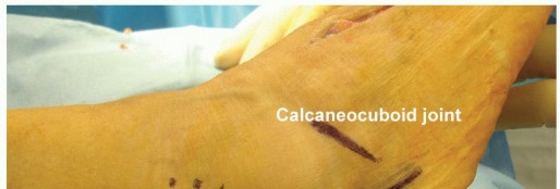 Illustration 7 for Lateral Column Lengthening: Relieve Flatfoot Pain & Correct Deformity