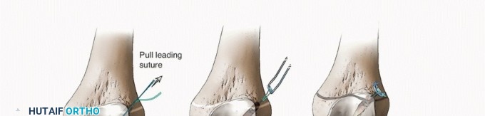 Illustration 23 for Preventing Growth Plate Risk: ACL Reconstruction Using Autogenous Grafts