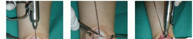 Illustration 11 for Painful Talus Lesions? The tech fig c Osteochondral Transfer Solution