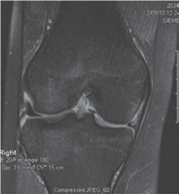 Knee Exam Prep: Meniscus Basic Science Questions to Master