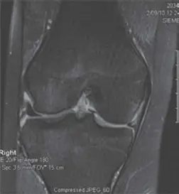 تمزق الغضروف الهلالي: دليلك الشامل للتشخيص والعلاج في صنعاء مع الأستاذ الدكتور محمد هطيف