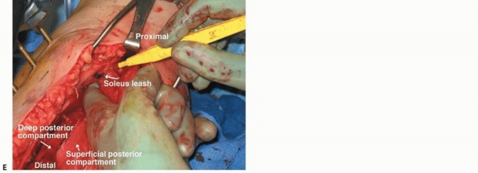 Illustration 19 for Acute Compartment Syndrome: Timely Fasciotomy Explained
