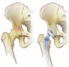 Illustration 2 for Advanced Arthroplasty for Malignant Lesions: Reclaim Your Mobility