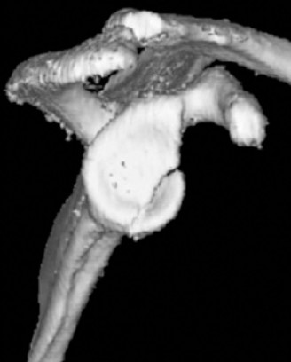 Illustration 5 for Right Shoulder Pain? Avoid This Common X-ray Mistake.