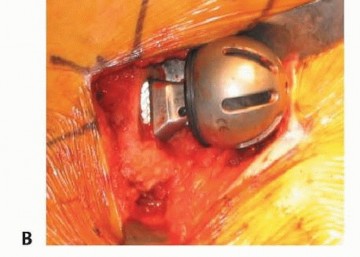 Illustration 35 for Hemiarthroplasty of the Hip: Indications & Types Explained