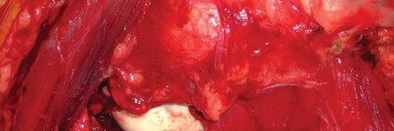 Illustration 38 for Navigating Early THA for Fractures of the Acetabulum