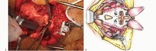 Illustration 36 for Sacral Tumor Surgery: Safeguarding Bowel & Bladder Control