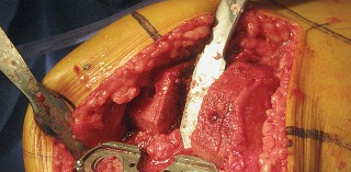 Illustration 51 for Posterior Stabilized Technique: Essential Insights for TKA Success