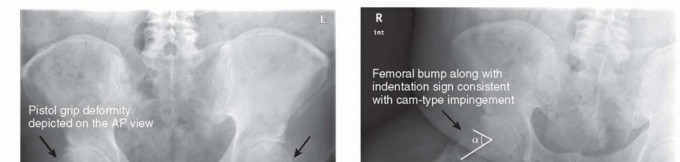 Illustration 10 for Anterior FAI Relief: Mini-Open Anterior Approach Explained