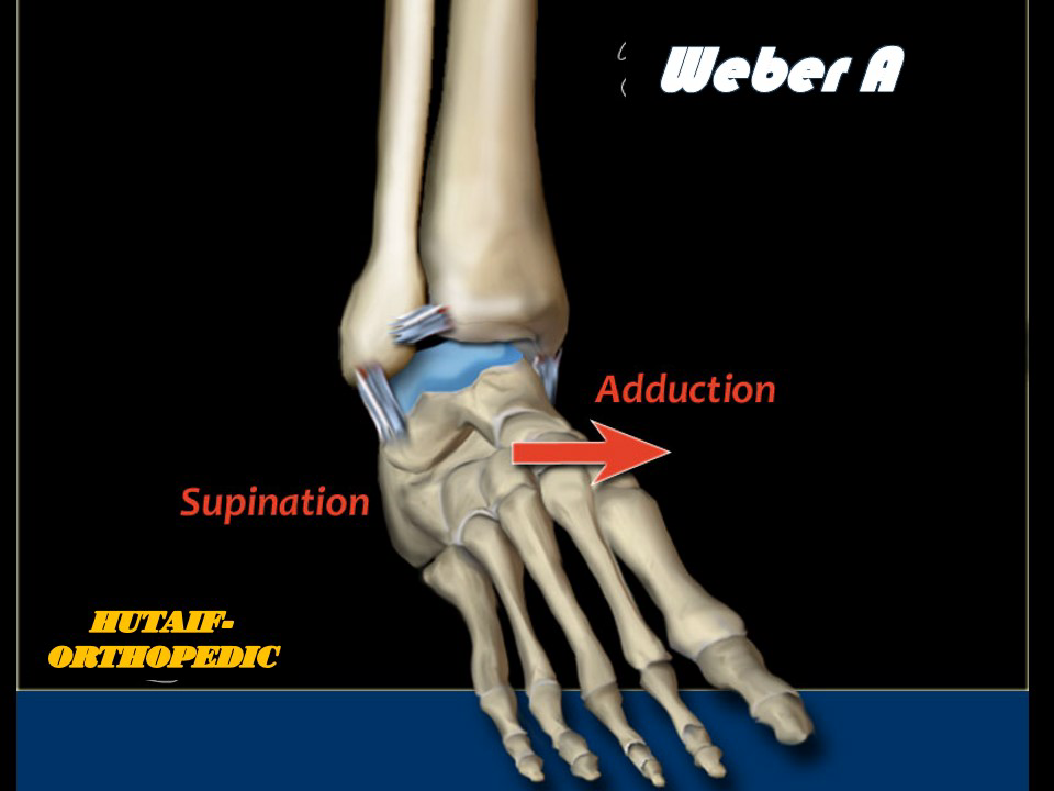 Illustration of ankle injuries weber - Dr. Mohammed Hutaif