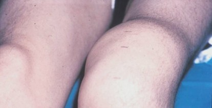 Illustration of type ii fibers - Dr. Mohammed Hutaif