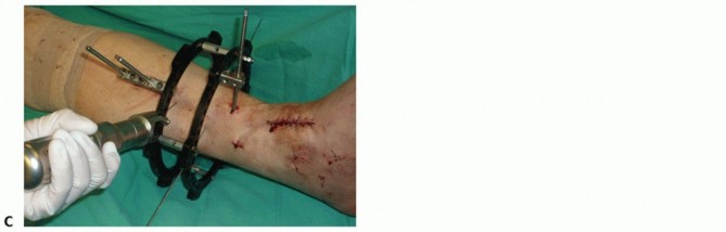 Illustration 42 for Optimize Pain Management with Proximal Ring Block for Ankle Arthrodesis