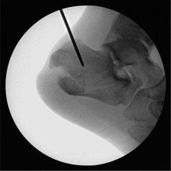Illustration 2 for Urgent Ankle Cases: What to Do for a 33-Year-Old Fracture?