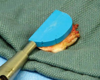 صورة طبية: جراحة استبدال مفصل الركبة الجزئي (UKA): تجنب الأخطاء والاستفادة القصوى في صنعاء مع الأستاذ الدكتور محمد هطيف