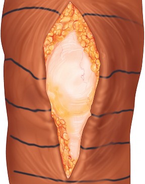 Illustration 2 for Monoblock Total Knee: When to Use & What to Avoid