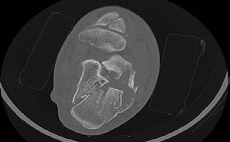 Illustration 2 for How to Manage Calcaneal Fracture After a 33-Year-Old Roofer Fell