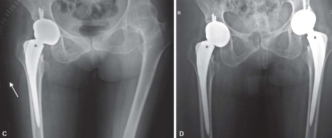 Illustration 54 for Total Hip Arthroplasty: Restoring Mobility in Juvenile Idiopathic Arthritis