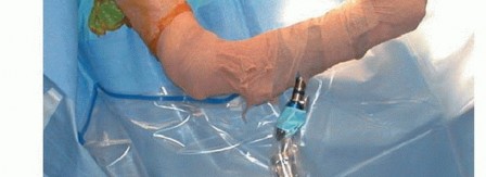 Illustration 8 for Stiff Shoulder? Discover Arthroscopic Capsular Release Solutions