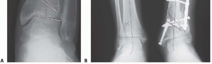 Illustration 3 for Distal Tibial Osteotomy: Fixing Varus & Valgus Ankle Alignment
