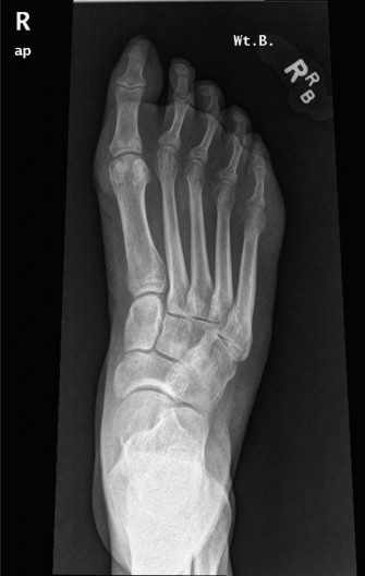 Unraveling Foot & Ankle Lumps: Is it Clear Cell Sarcoma?