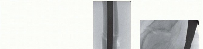 Illustration 21 for Pediatric Femoral Nailing: Targeting the Right aspect of the greater Trochanter