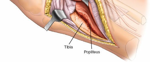 Illustration 44 for Surgical Access: Mastering the Tibia's Surface & Fibula Approaches