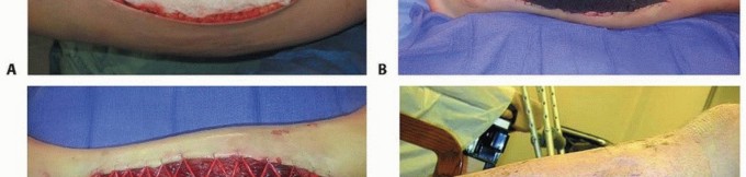 Illustration 23 for Acute Compartment Syndrome: Timely Fasciotomy Explained