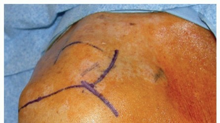 Illustration 7 for Subscapularis & Teres Rotator Cuff Repair: Advanced Techniques