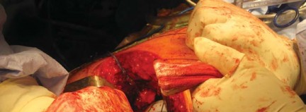 Illustration 33 for Metal on Metal Resurfacing: Enhanced Posterior Soft Tissue Repair