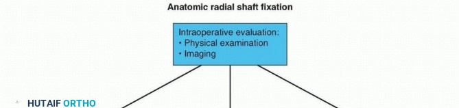 Illustration 9 for Galeazzi DRUJ Stabilization: Unlocking Stability with Smooth Stainless Steel