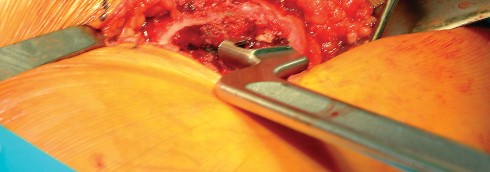 Illustration 61 for Direct Lateral Hip: Optimize Exposure with Sharp Curved Hohmann