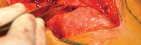 Illustration 29 for Direct Lateral Hip: Optimize Exposure with Sharp Curved Hohmann