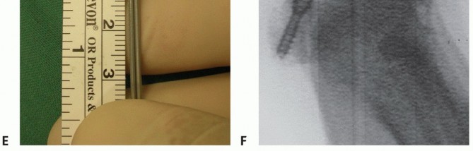 Illustration 15 for Optimizing Internal Fixation of Sesamoid Fractures