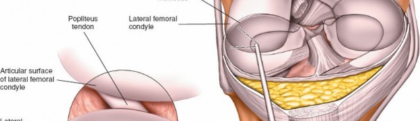 Illustration 25 for Mastering Knee Arthroscopy Approaches: Safely Withdraw the Arthroscope