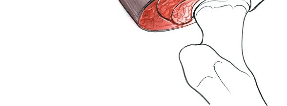 Illustration 30 for Unlocking Every Aspect of the Hip's Surgical Approaches