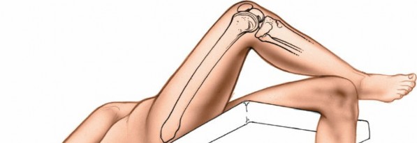 Illustration 134 for Mastering Knee Approaches: Spotlight on Superficial Medial Ligament